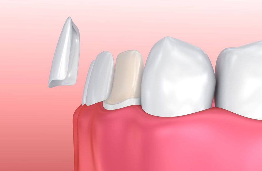 Illustration of porcelain veneers