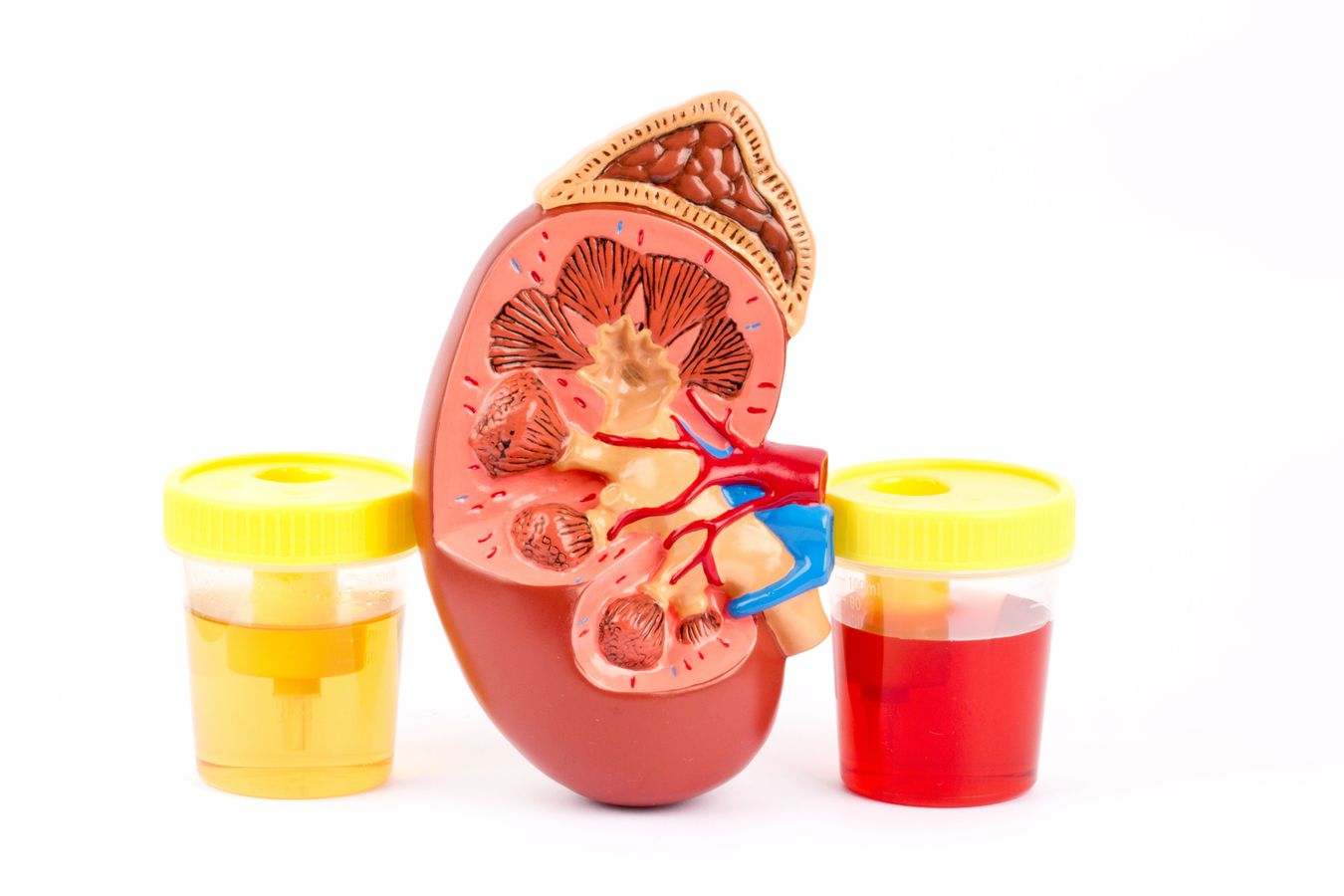 Kidney model and example of normal urine and urine with blood