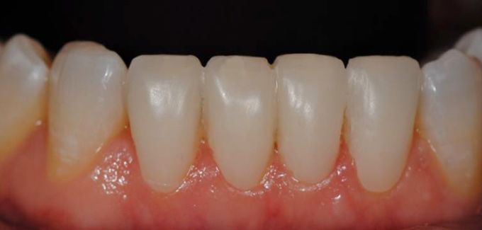 After veneers