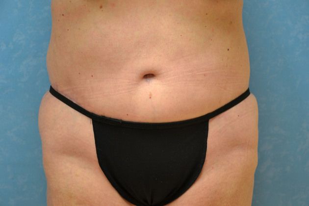 Tummy tuck, after.