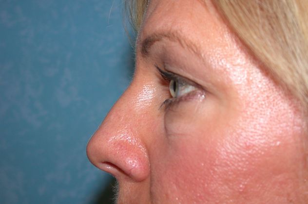 Before image of a blepharoplasty patient.