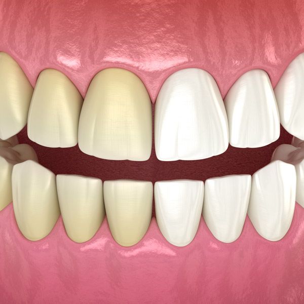 yellow teeth transitioning into white teeth