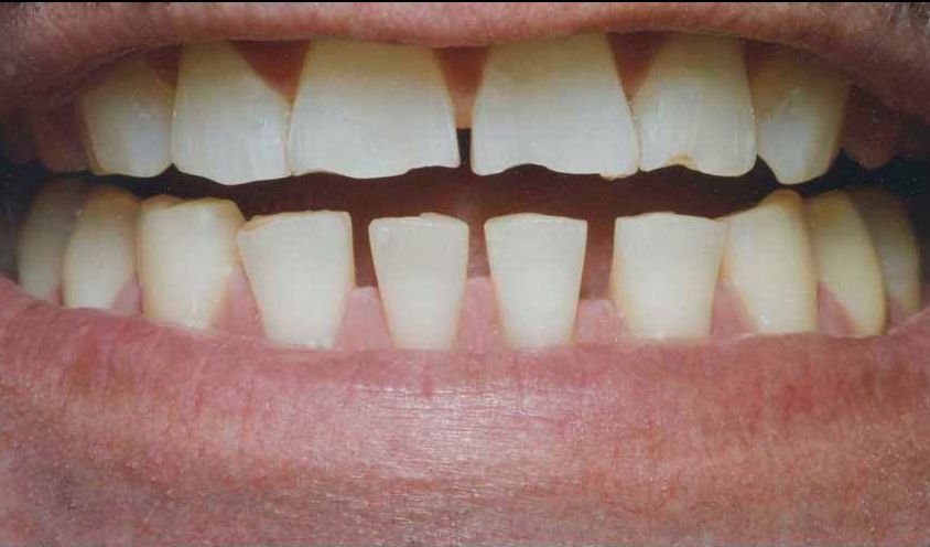 Koyfman Dental patient before smile makeover