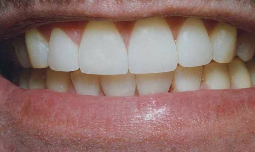 Koyfman Dental patient after smile makeover