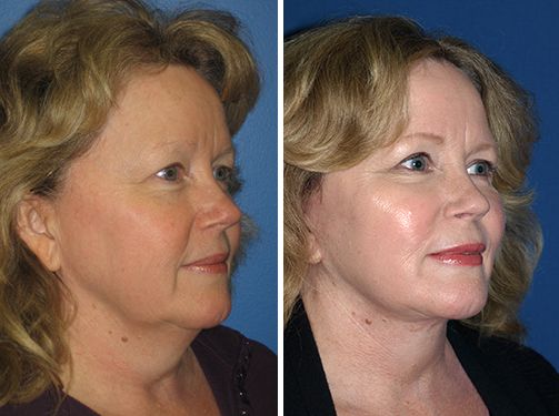 Mini facelift after photo