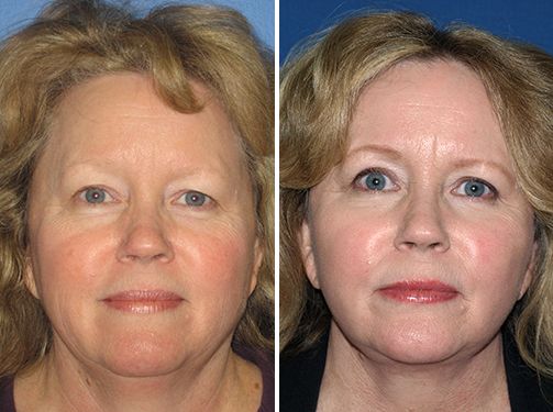 Mini facelift before photo