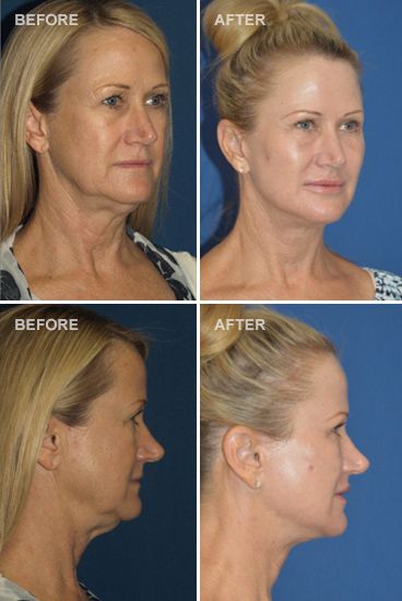 Before and after facelift photo