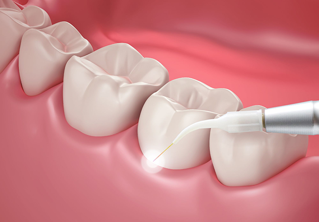 laser dentistry