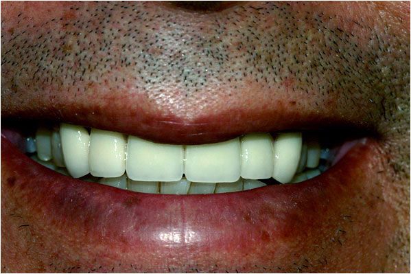 after dental crowns