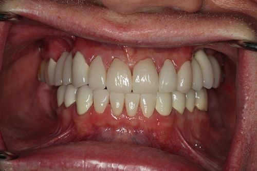 After Dental Implants