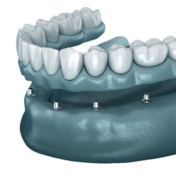 implant-supported dentures