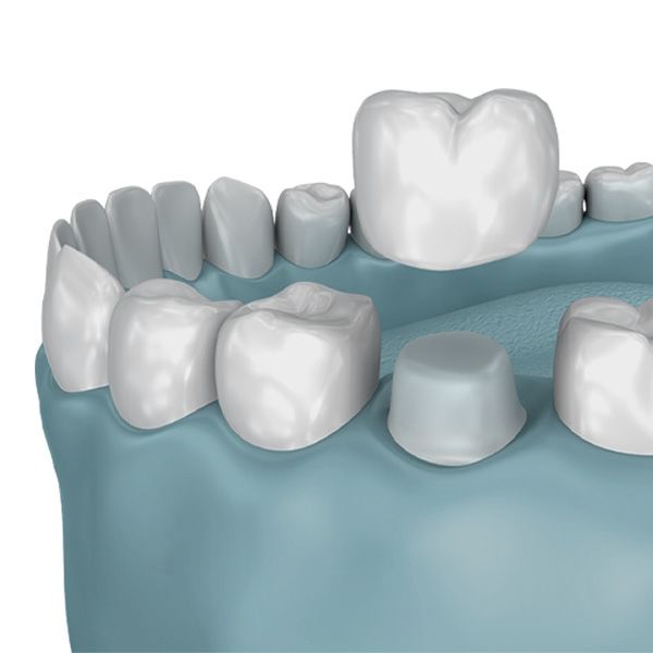 An illustration of a dental crown being placed on a tooth