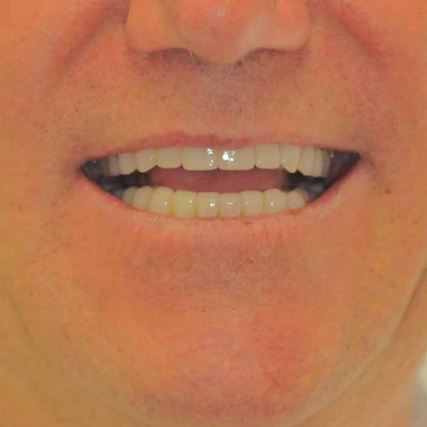 After dental implants