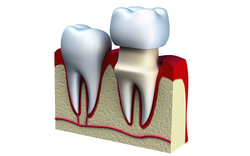 A crown is fitted on top of a reshaped tooth.