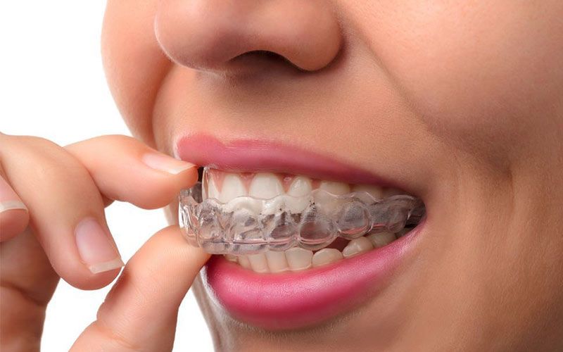 A woman puts on an Invisalign retainer.