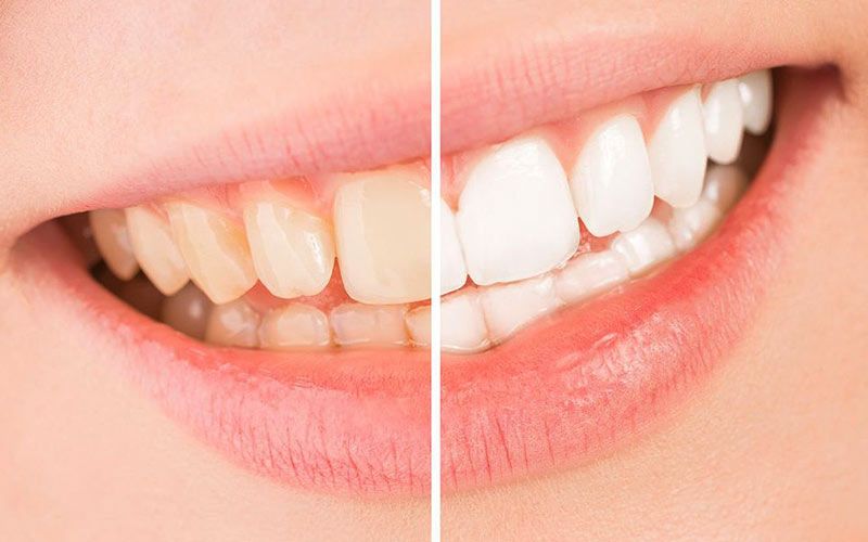 Demonstration of yellowed teeth before treatment and white teeth after treatment.