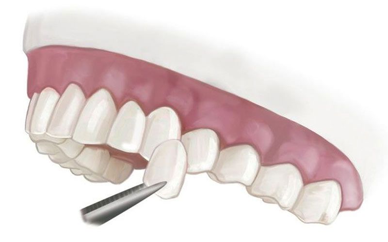 A veneer is placed on top of one of the front teeth.