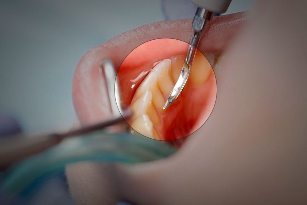 teeth cleaning