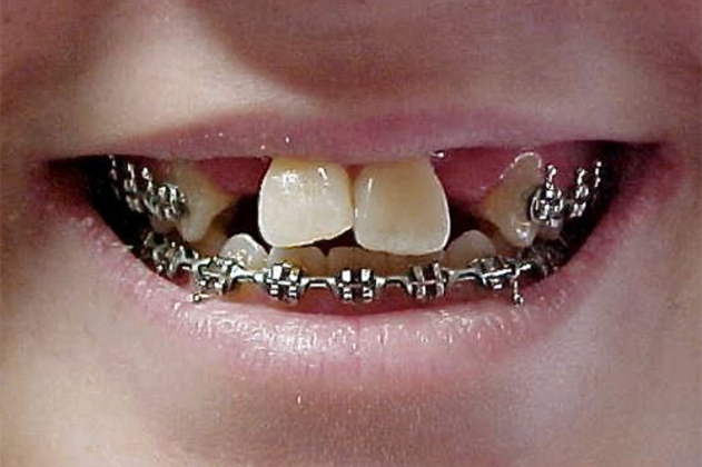 Patient missing front teeth with braces