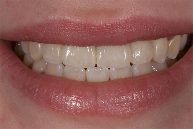 Patient after dental implants