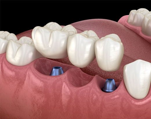 implant-supported bridge