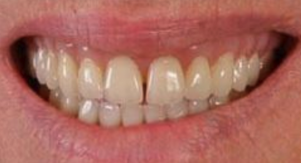 After implant-supported dentures.