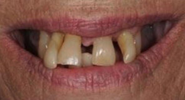 Before implant-supported dentures.