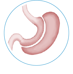 A stomach after undergoing gastric sleeve surgery.