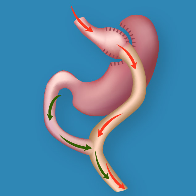 Gastric Bypass