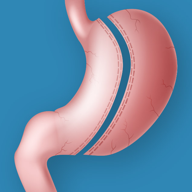 Gastric Sleeve