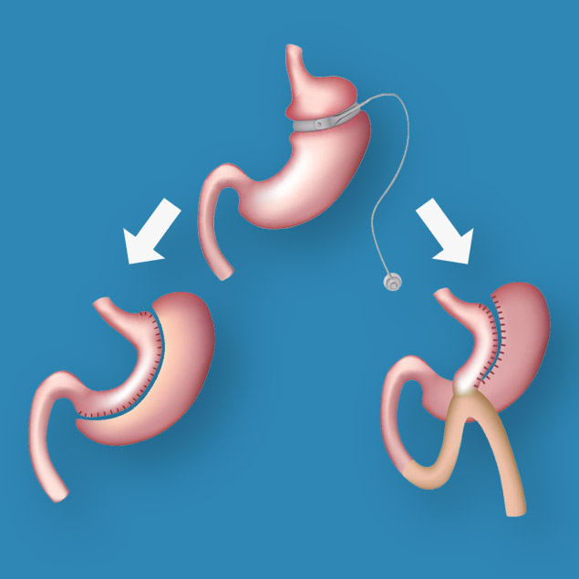 Bariatric Revision Surgery