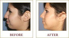 A young woman before and after she has received a rhinoplasty