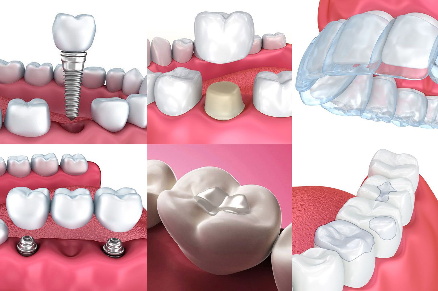 full mouth reconstruction treatments