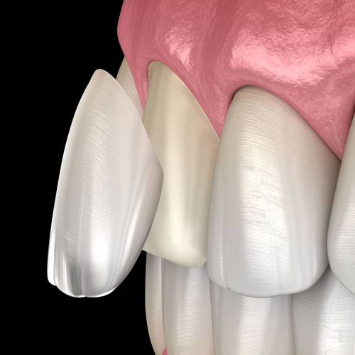 Illustration of veneer