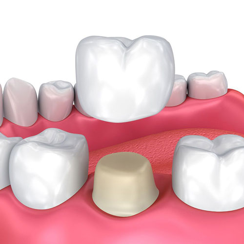Illustration of traditional dental crown