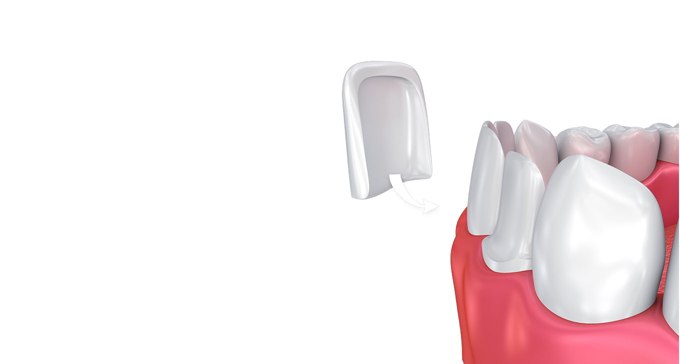 dental veneers