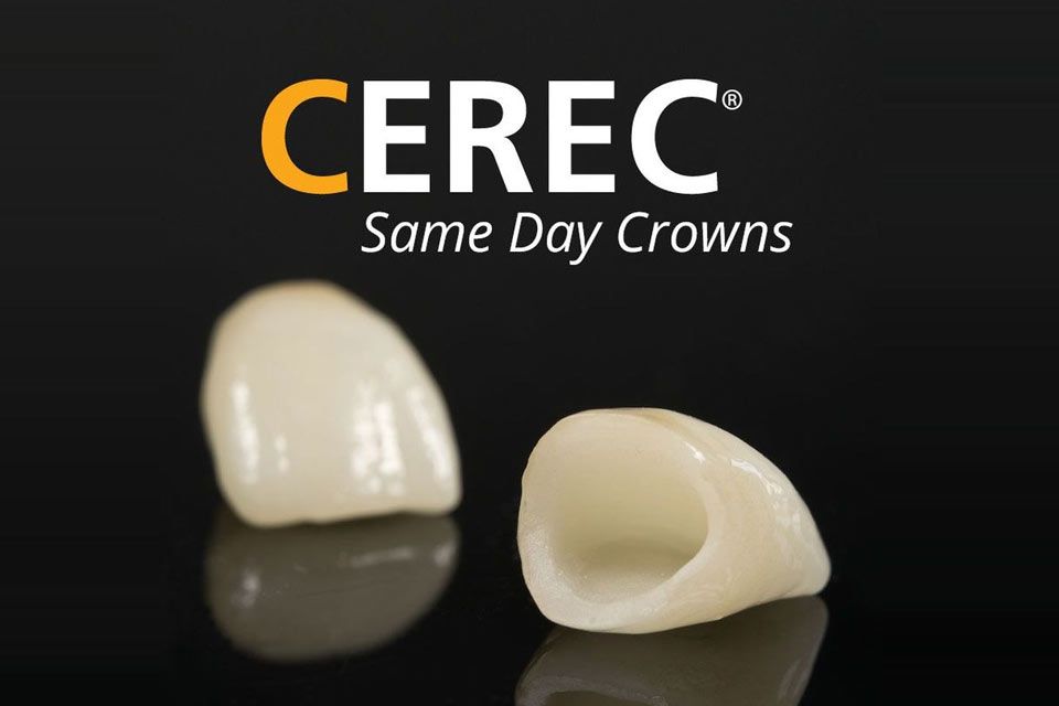 CEREC same-day crowns