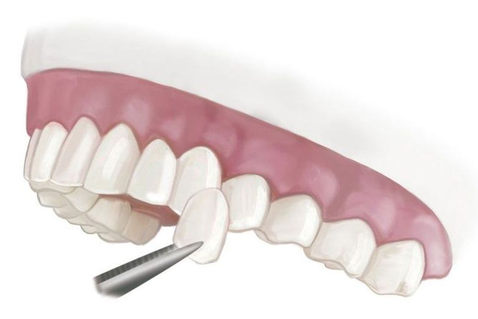 porcelain veneers