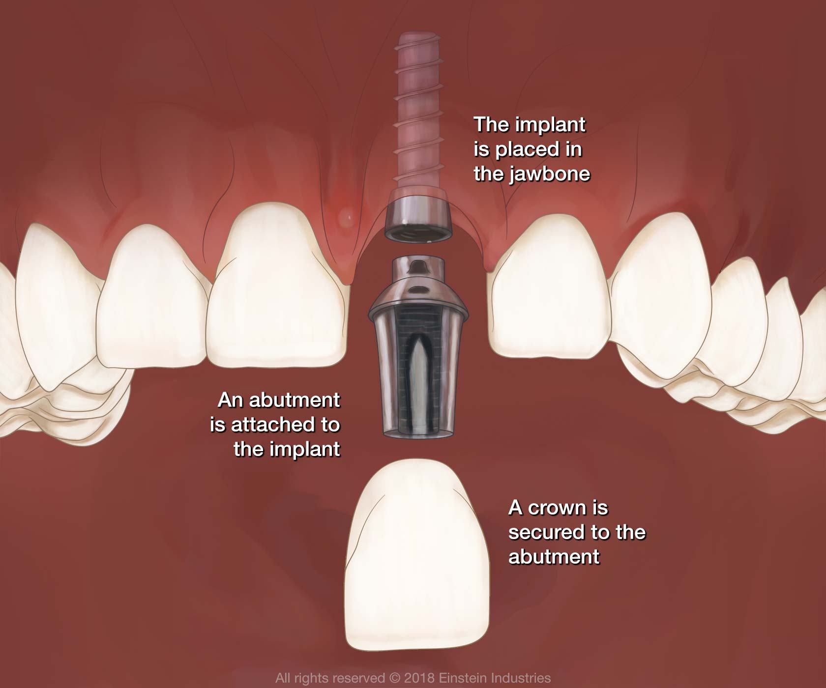 diagram of implants