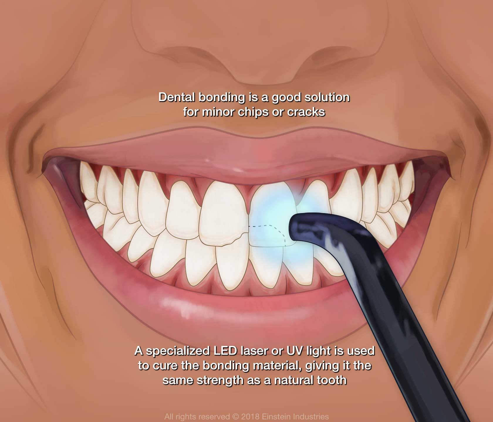 Dental Bonding Troy MI Birmingham MI Bloomfield MI Cosmetic Dental Bonding Troy MI Birmingham MI Bloomfield MI Cosmetic