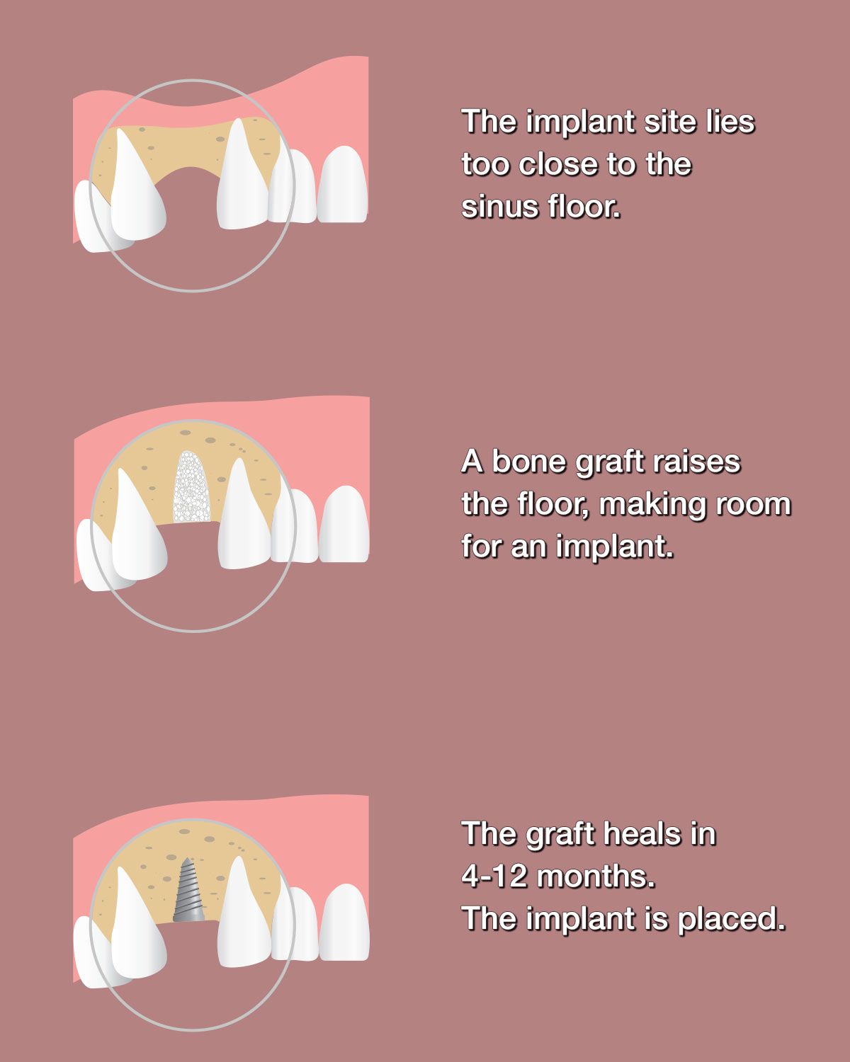 Illustration of sinus lift