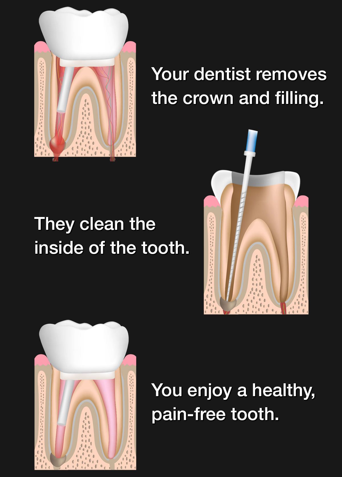 Illustration of root canal retreatment