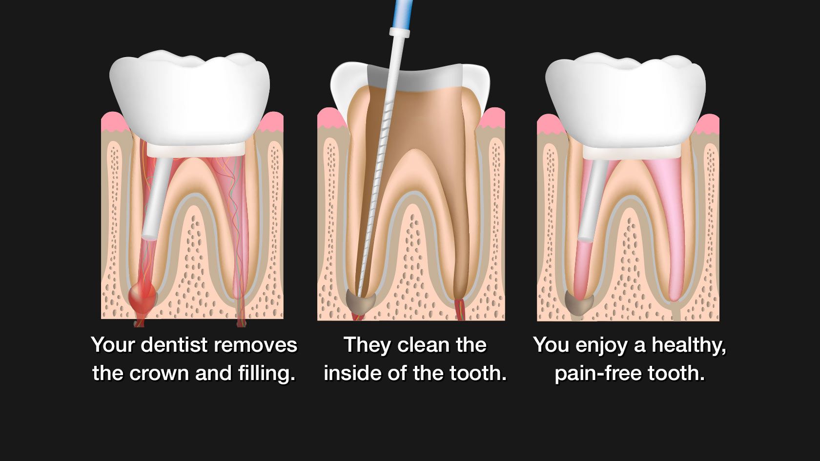 Illustration of root canal retreatment