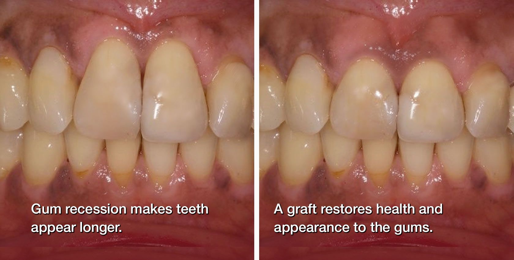 Before and after gum grafting