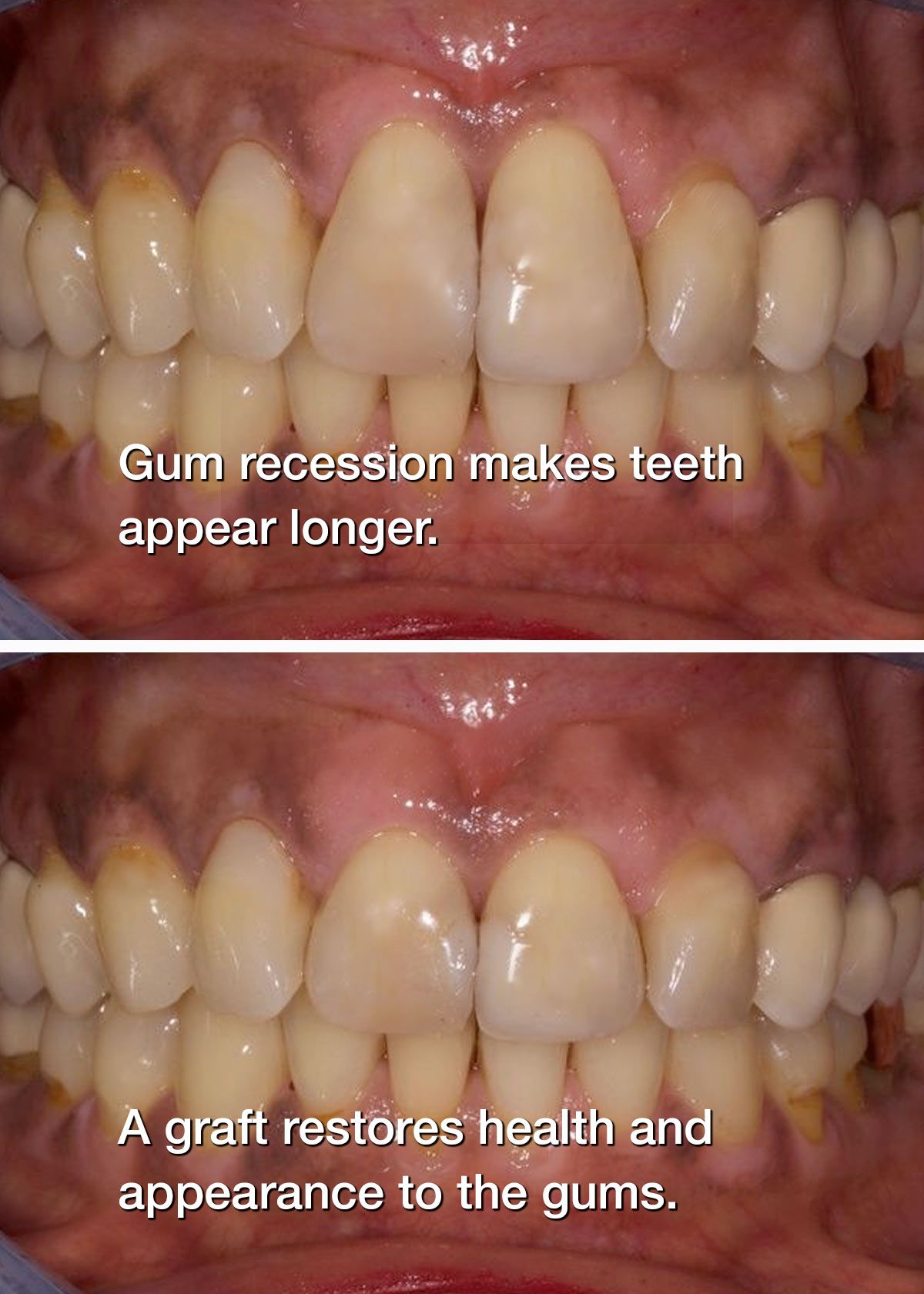 Before and after gum grafting
