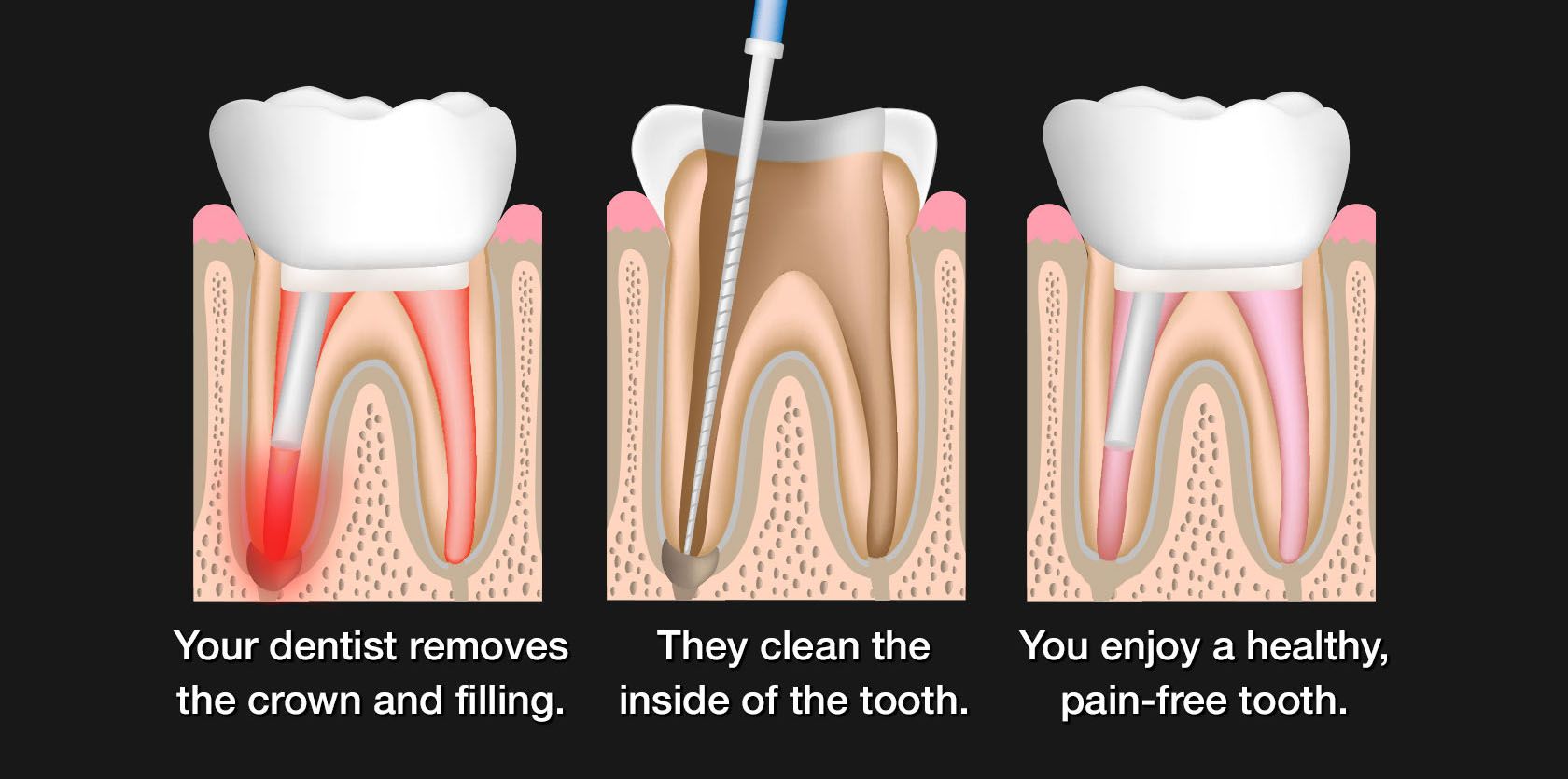 Illustration of root canal retreatment