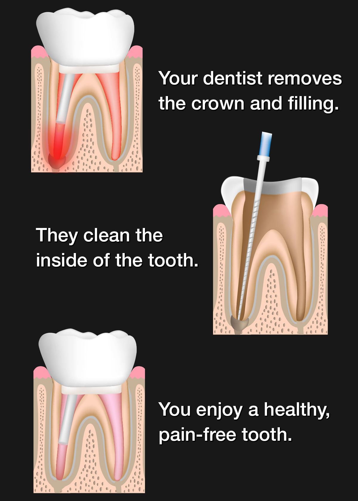 Illustration of root canal retreatment