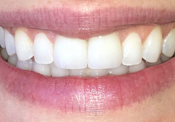 A beautiful smile without gaps