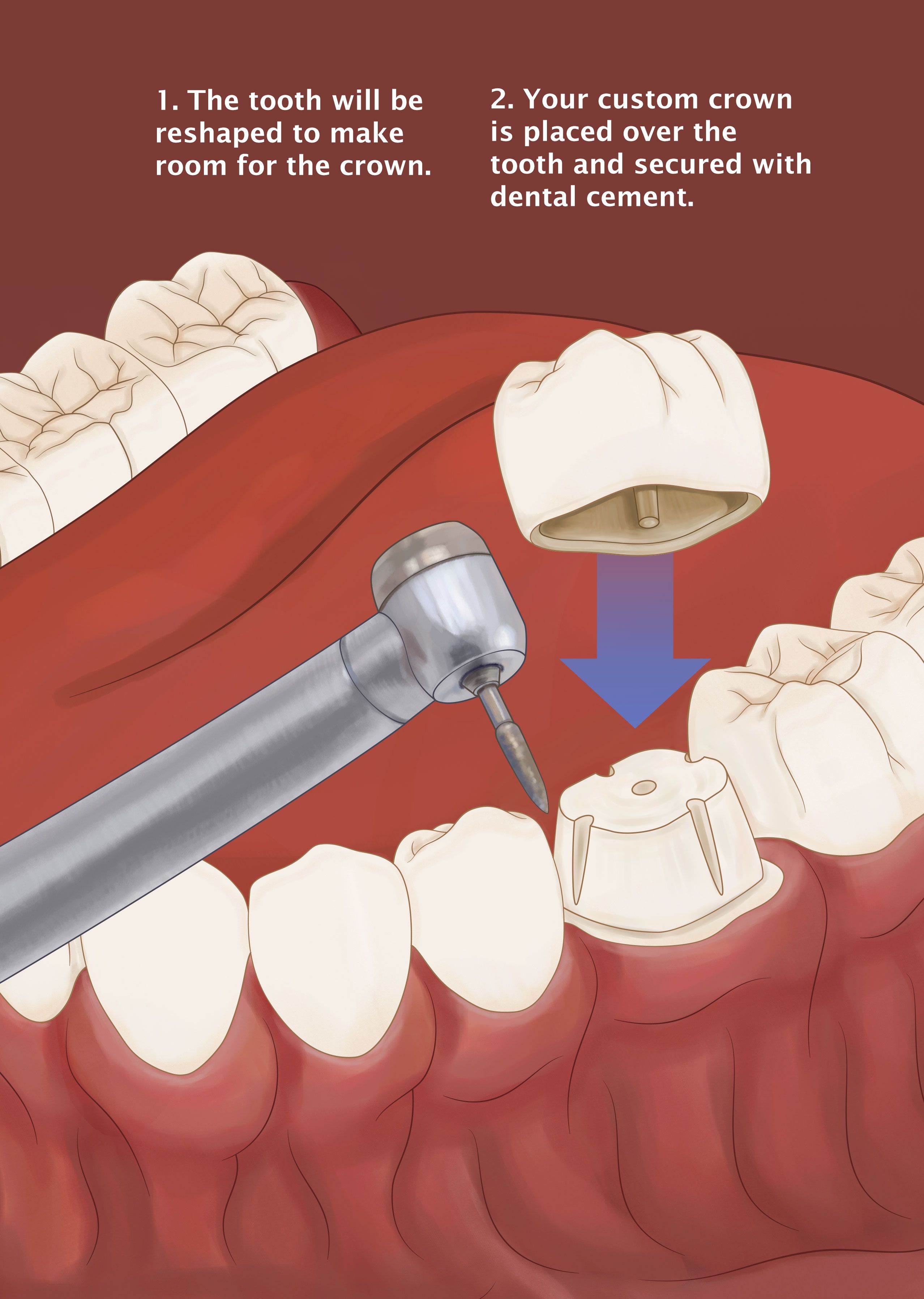 Dental Crown Brazoria TX Osga Dental Dr Adam Osga Dentist Dental Crown Brazoria TX Osga Dental Dr Adam Osga Dentist