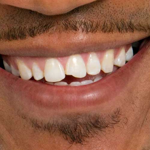 Chipped tooth